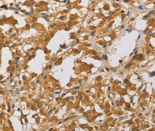 Immunohistochemistry of paraffin-embedded Human thyroid cancer tissue using ARHGEF5 Polyclonal Antibody at dilution 1:40