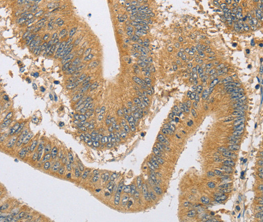 Immunohistochemistry of paraffin-embedded Human colon cancer tissue using ARHGEF1 Polyclonal Antibody at dilution 1:60