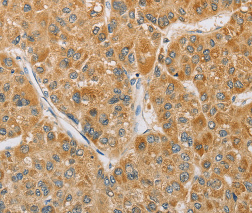 Immunohistochemistry of paraffin-embedded Human liver cancer tissue using ARHGEF1 Polyclonal Antibody at dilution 1:60