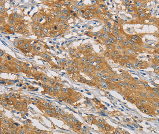 Immunohistochemistry of paraffin-embedded Human gastic cancer using ARHGEF7 Polyclonal Antibody at dilution of 1:40