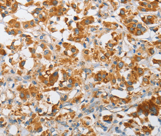 Immunohistochemistry of paraffin-embedded Human thyroid cancer using ARHGEF9 Polyclonal Antibody at dilution of 1:50