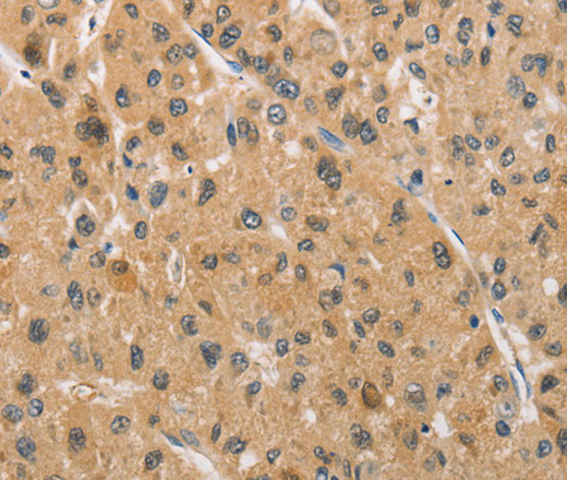 Immunohistochemistry of paraffin-embedded Human liver cancer tissue using ARMCX1 Polyclonal Antibody at dilution 1:40