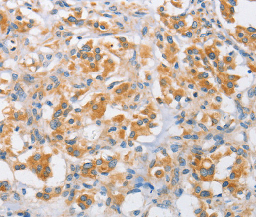 Immunohistochemistry of paraffin-embedded Human thyroid cancer tissue using ARMCX1 Polyclonal Antibody at dilution 1:40