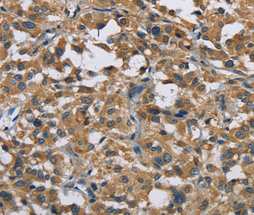 Immunohistochemistry of paraffin-embedded Human thyroid cancer tissue using GAB1 Polyclonal Antibody at dilution 1:40