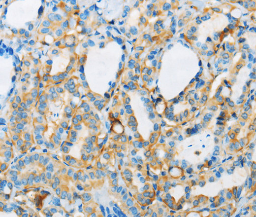 Immunohistochemistry of paraffin-embedded Human thyroid cancer tissue using ARSA Polyclonal Antibody at dilution 1:50