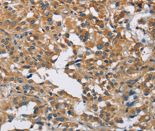 Immunohistochemistry of paraffin-embedded Human thyroid cancer tissue using DNMT3A Polyclonal Antibody at dilution 1:50