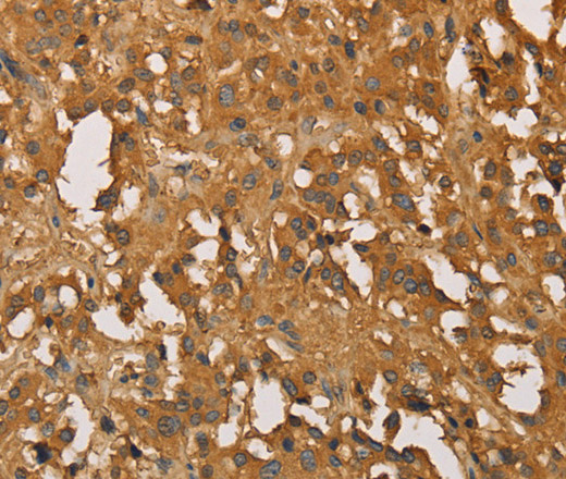 Immunohistochemistry of paraffin-embedded Human thyroid cancer tissue using SETD2 Polyclonal Antibody at dilution 1:30