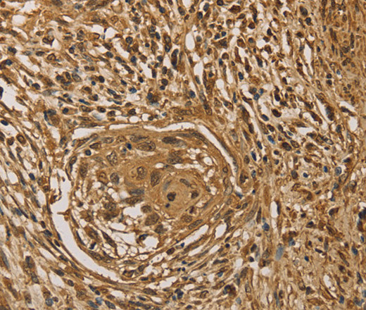 Immunohistochemistry of paraffin-embedded Human cervical cancer tissue using PRDM14 Polyclonal Antibody at dilution 1:40