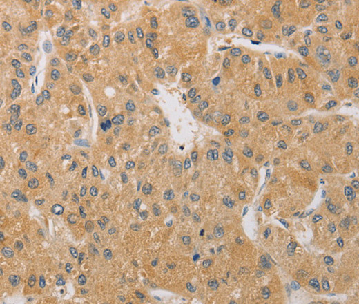 Immunohistochemistry of paraffin-embedded Human liver cancer tissue using ARSK Polyclonal Antibody at dilution 1:30