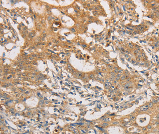 Immunohistochemistry of paraffin-embedded Human gastric cancer tissue using ARSG Polyclonal Antibody at dilution 1:30