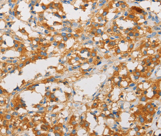 Immunohistochemistry of paraffin-embedded Human thyroid cancer tissue using ART3 Polyclonal Antibody at dilution 1:40