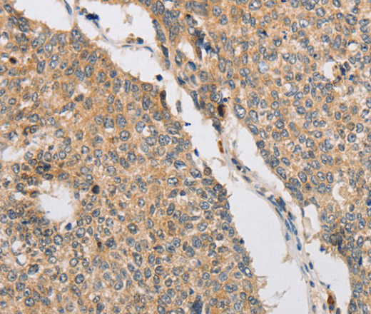 Immunohistochemistry of paraffin-embedded Human lung cancer tissue using ART3 Polyclonal Antibody at dilution 1:40