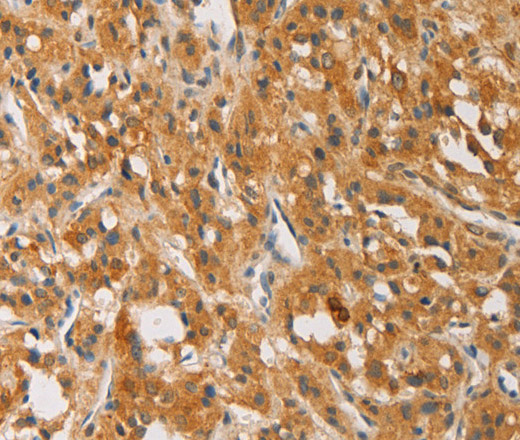 Immunohistochemistry of paraffin-embedded Human thyroid cancer tissue using ATG4D Polyclonal Antibody at dilution 1:40