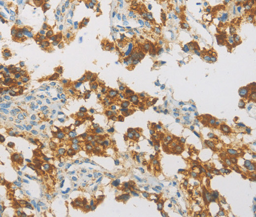 Immunohistochemistry of paraffin-embedded Human thyroid cancer using IDH3G Polyclonal Antibody at dilution of 1:30