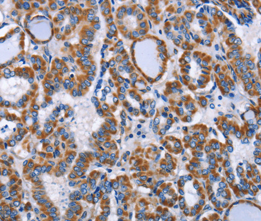 Immunohistochemistry of paraffin-embedded Human thyroid cancer tissue using INTS10 Polyclonal Antibody at dilution 1:50