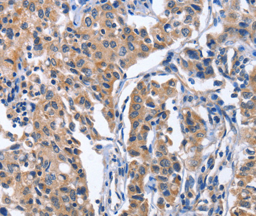 Immunohistochemistry of paraffin-embedded Human lung cancer tissue using INTS10 Polyclonal Antibody at dilution 1:50