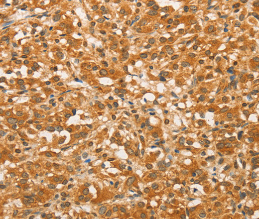 Immunohistochemistry of paraffin-embedded Human thyroid cancer tissue using BCL2L14 Polyclonal Antibody at dilution 1:40