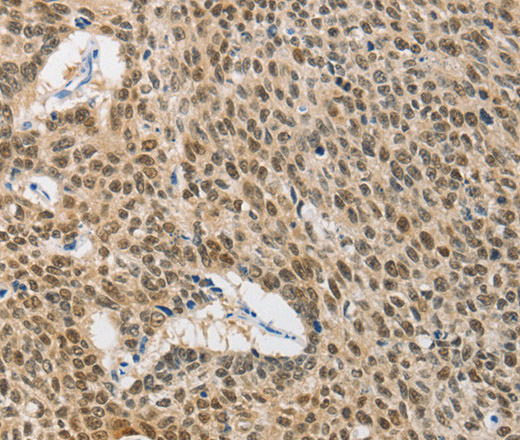 Immunohistochemistry of paraffin-embedded Human lung cancer using HSP40 Polyclonal Antibody at dilution of 1:40