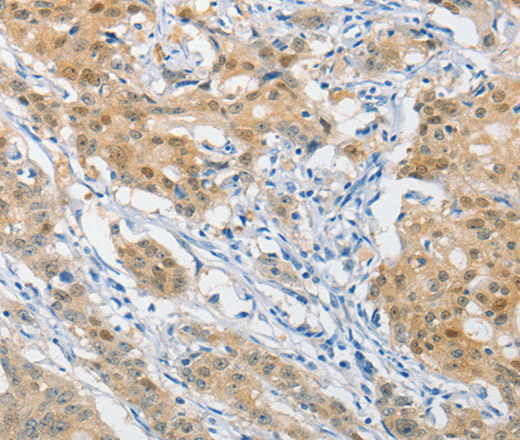 Immunohistochemistry of paraffin-embedded Human gastric cancer using HSP40 Polyclonal Antibody at dilution of 1:40