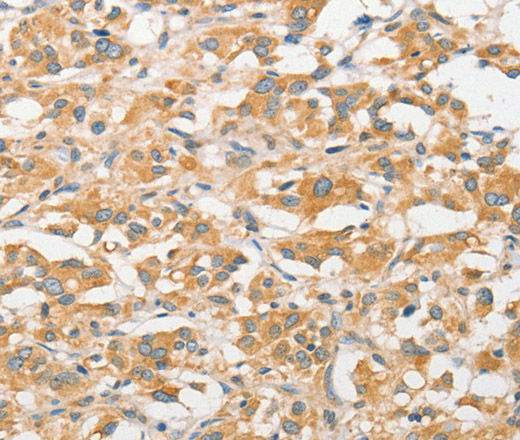 Immunohistochemistry of paraffin-embedded Human thyroid cancer tissue using TLR5 Polyclonal Antibody at dilution 1:30