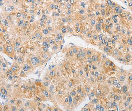 Immunohistochemistry of paraffin-embedded Human liver cancer tissue using TLR5 Polyclonal Antibody at dilution 1:30