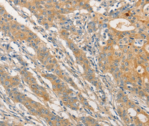 Immunohistochemistry of paraffin-embedded Human gasrtic cancer tissue using STAM Polyclonal Antibody at dilution 1:40