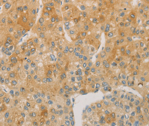 Immunohistochemistry of paraffin-embedded Human liver cancer using ACSL4 Polyclonal Antibody at dilution of 1:60