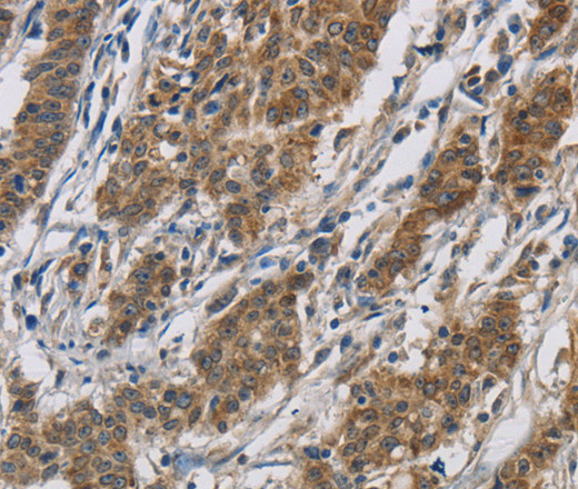 Immunohistochemistry of paraffin-embedded Human gastic cancer using SIGMAR1 Polyclonal Antibody at dilution of 1:50