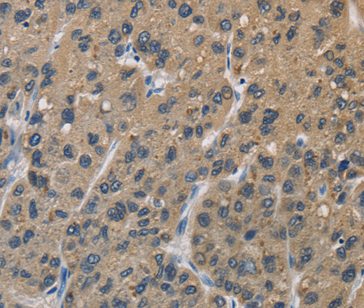 Immunohistochemistry of paraffin-embedded Human liver cancer using SIGMAR1 Polyclonal Antibody at dilution of 1:50