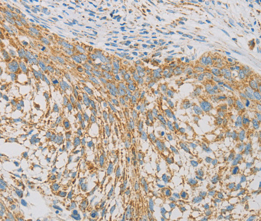 Immunohistochemistry of paraffin-embedded Human cervical cancer tissue using REN Polyclonal Antibody at dilution 1:40