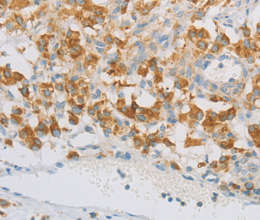 Immunohistochemistry of paraffin-embedded Human thyroid cancer tissue using REN Polyclonal Antibody at dilution 1:40