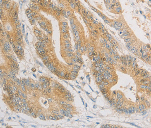 Immunohistochemistry of paraffin-embedded Human colon cancer tissue using ZWINT Polyclonal Antibody at dilution 1:50