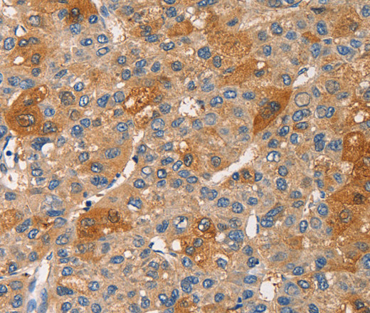 Immunohistochemistry of paraffin-embedded Human liver cancer tissue using PKC epsilon Polyclonal Antibody at dilution 1:30