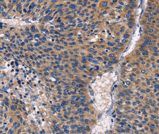 Immunohistochemistry of paraffin-embedded Human liver cancer using PKC delta Polyclonal Antibody at dilution of 1:30