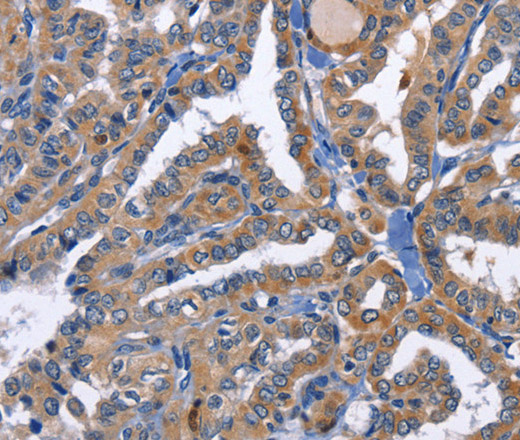 Immunohistochemistry of paraffin-embedded Human thyroid cancer using PKC delta Polyclonal Antibody at dilution of 1:30