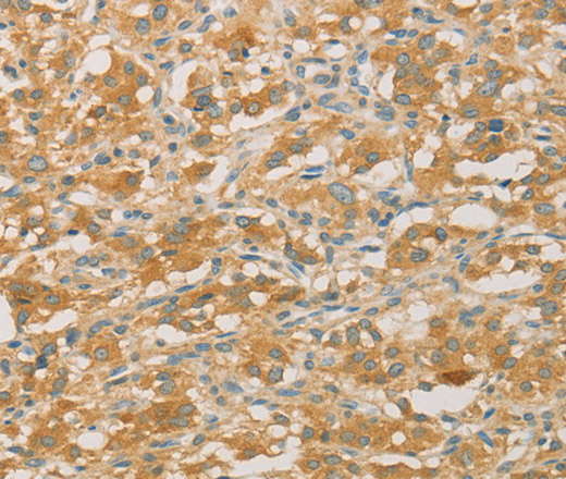 Immunohistochemistry of paraffin-embedded Human thyroid cancer tissue using PRPSAP1 Polyclonal Antibody at dilution 1:50