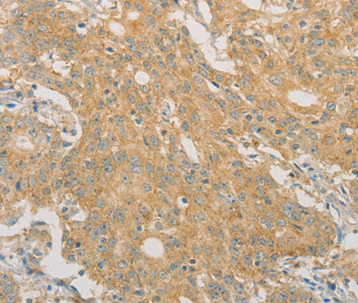 Immunohistochemistry of paraffin-embedded Human gastric cancer tissue using PRPSAP1 Polyclonal Antibody at dilution 1:50