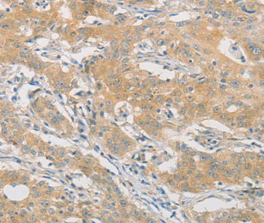 Immunohistochemistry of paraffin-embedded Human gasrtic cancer tissue using HIPK4 Polyclonal Antibody at dilution 1:30