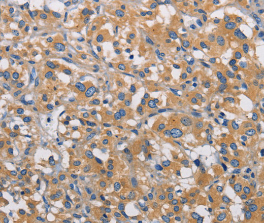 Immunohistochemistry of paraffin-embedded Human thyroid cancer tissue using PIKFYVE Polyclonal Antibody at dilution 1:30