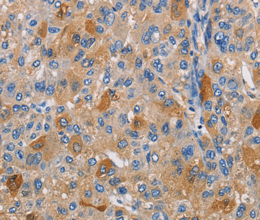 Immunohistochemistry of paraffin-embedded Human liver cancer tissue using PIKFYVE Polyclonal Antibody at dilution 1:30