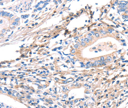 Immunohistochemistry of paraffin-embedded Human gastric cancer using TWF2 Polyclonal Antibody at dilution of 1:40