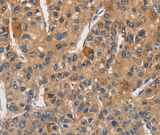 Immunohistochemistry of paraffin-embedded Human liver cancer tissue using RICTOR Polyclonal Antibody at dilution 1:40