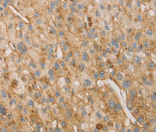 Immunohistochemistry of paraffin-embedded Human liver cancer tissue using VTN Polyclonal Antibody at dilution 1:40