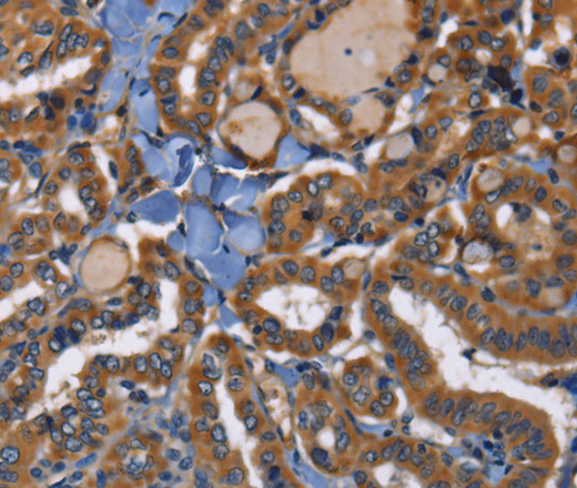 Immunohistochemistry of paraffin-embedded Human thyroid cancer tissue using EPHB6 Polyclonal Antibody at dilution 1:40