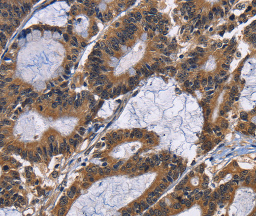 Immunohistochemistry of paraffin-embedded Human colon cancer tissue using EPHB6 Polyclonal Antibody at dilution 1:40