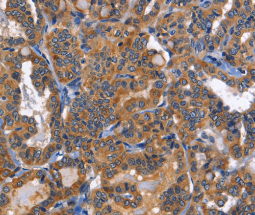 Immunohistochemistry of paraffin-embedded Human thyroid cancer tissue using MUSK Polyclonal Antibody at dilution of 1:40