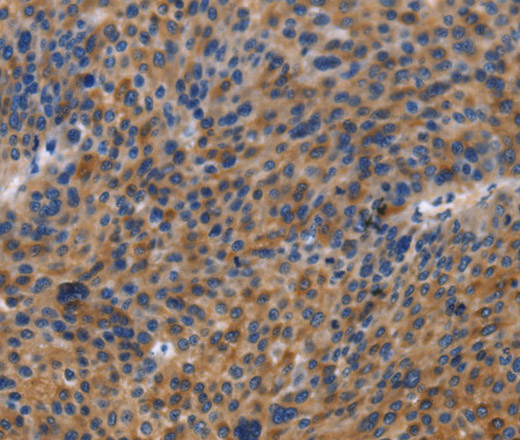 Immunohistochemistry of paraffin-embedded Human liver cancer using MUSK Polyclonal Antibody at dilution of 1:40