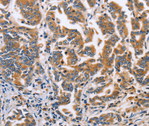 Immunohistochemistry of paraffin-embedded Human gasrtic cancer tissue using DOK4 Polyclonal Antibody at dilution 1:60