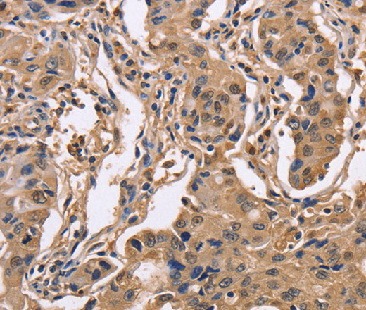 Immunohistochemistry of paraffin-embedded Human lung cancer using IDH1 Polyclonal Antibody at dilution of 1:50