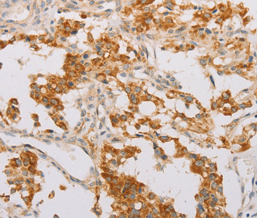 Immunohistochemistry of paraffin-embedded Human thyroid cancer tissue using STK40 Polyclonal Antibody at dilution 1:40